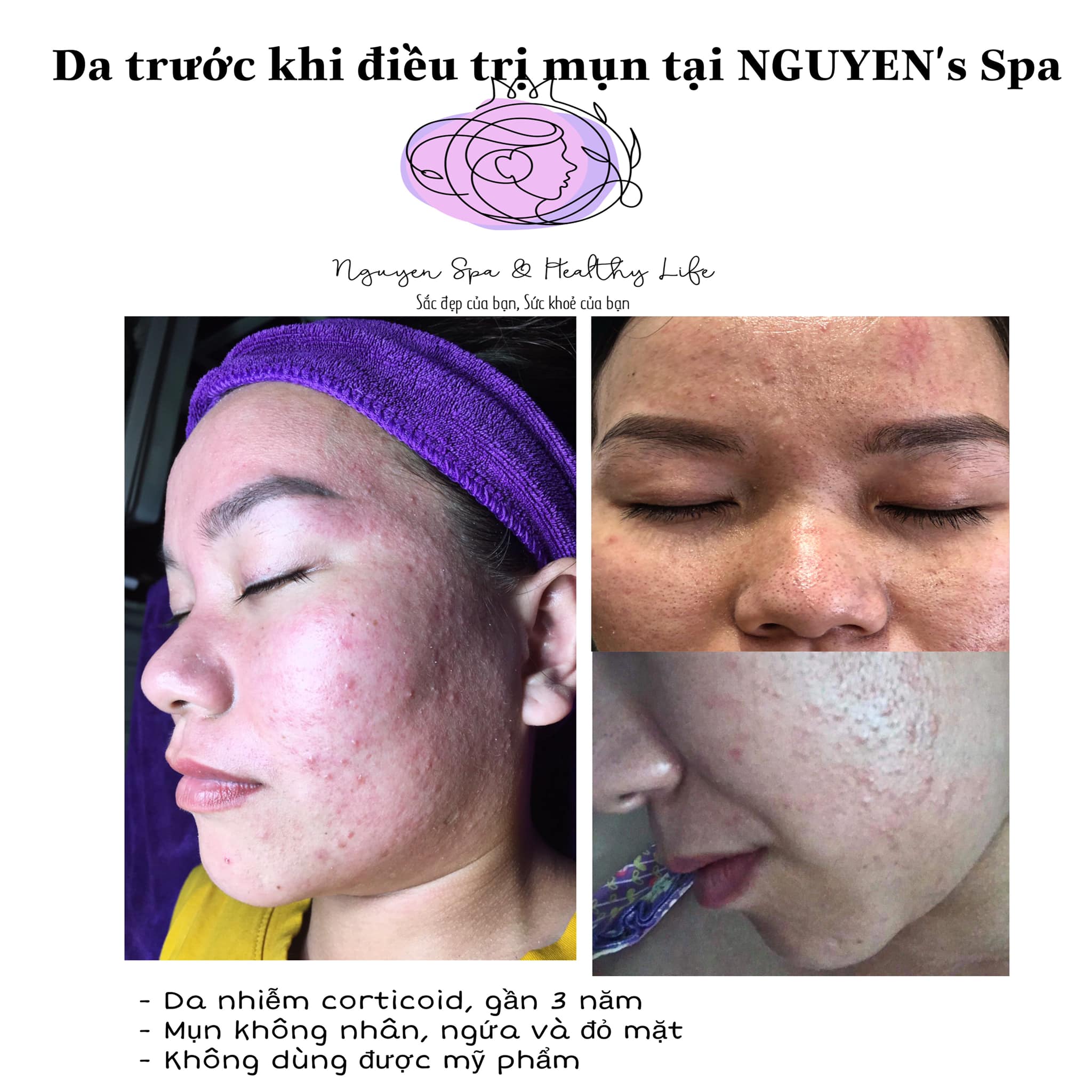 Feedback thực tế của khách hàng điều trị mụn tại NGUYEN's SPA 