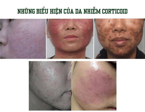 Những biểu hiện của da nhiễm Corticoid 